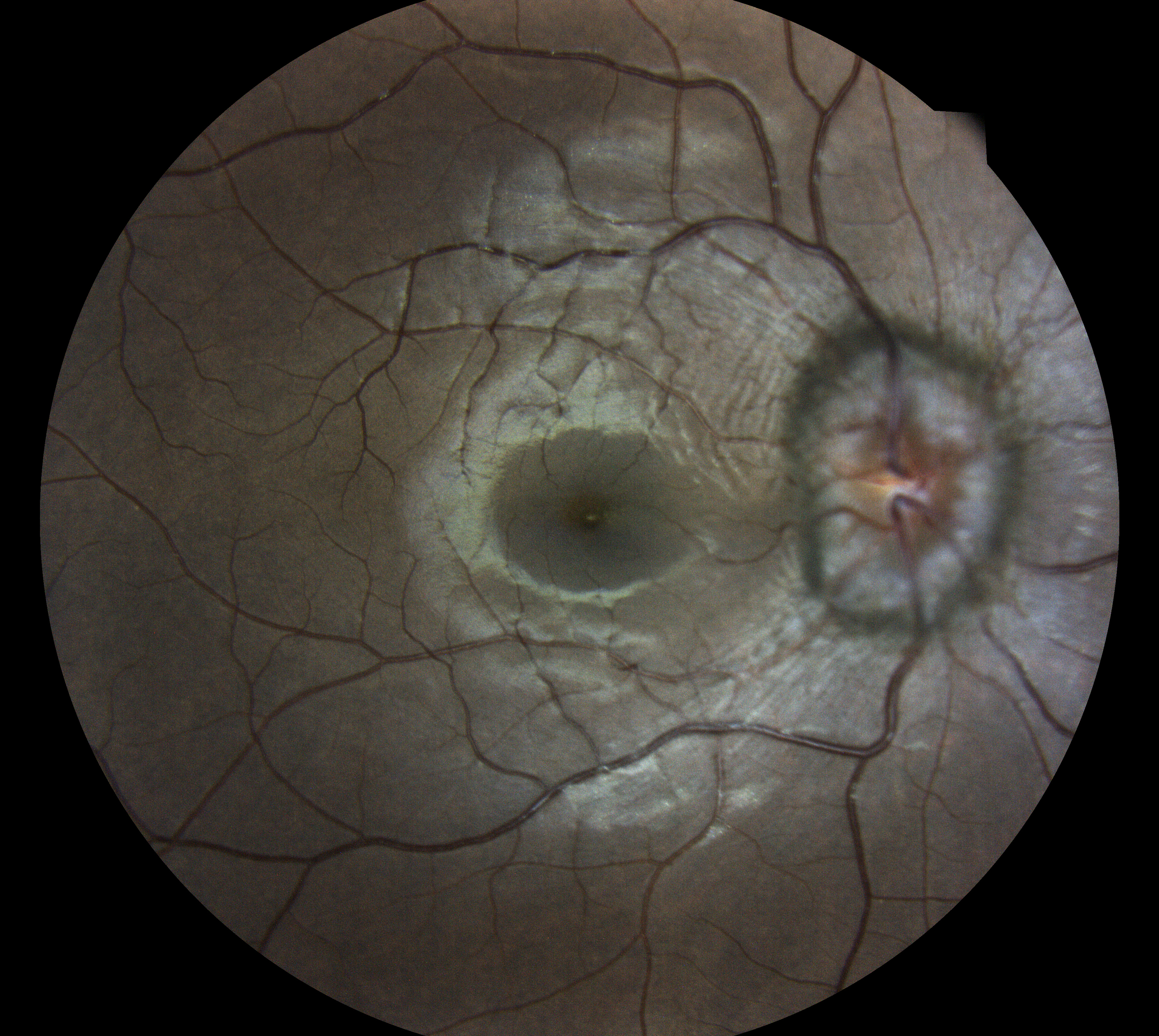  Courtesy of Pr Pierre Labalette, Lille, France 