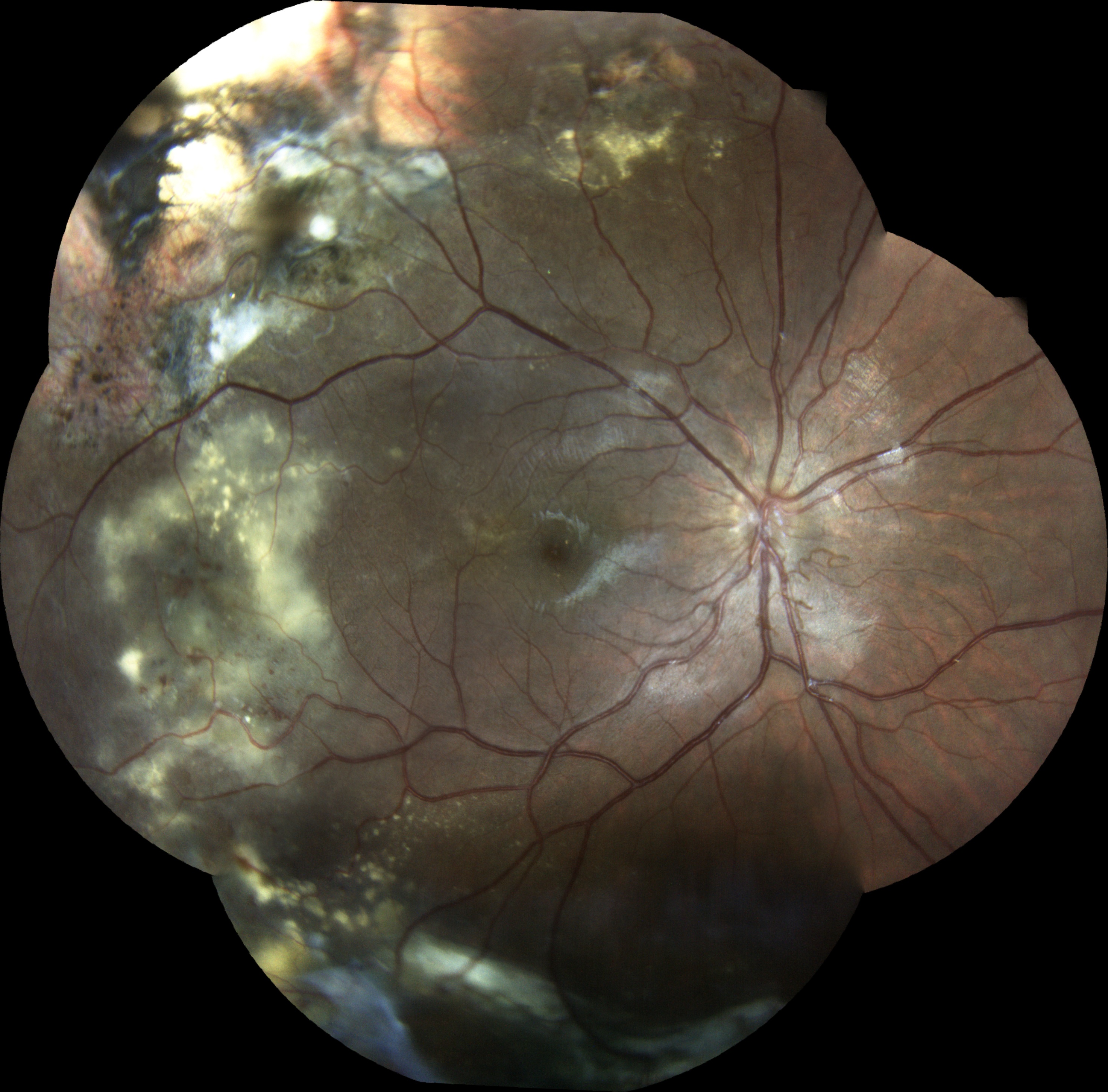  Courtesy of Pr Pierre Labalette, Lille, France 