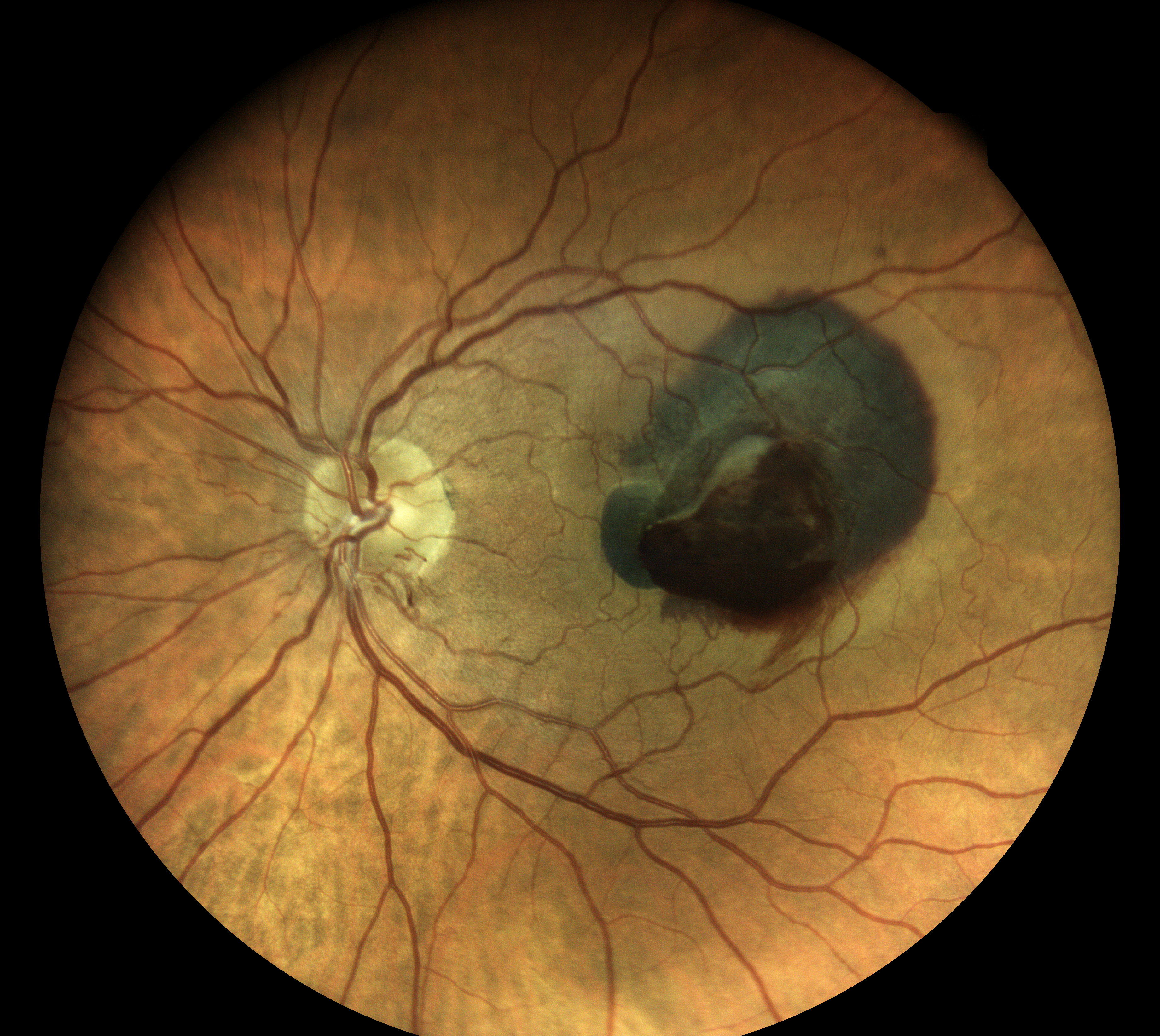  Courtesy of Dr Vincent Gualino, Montauban, France 