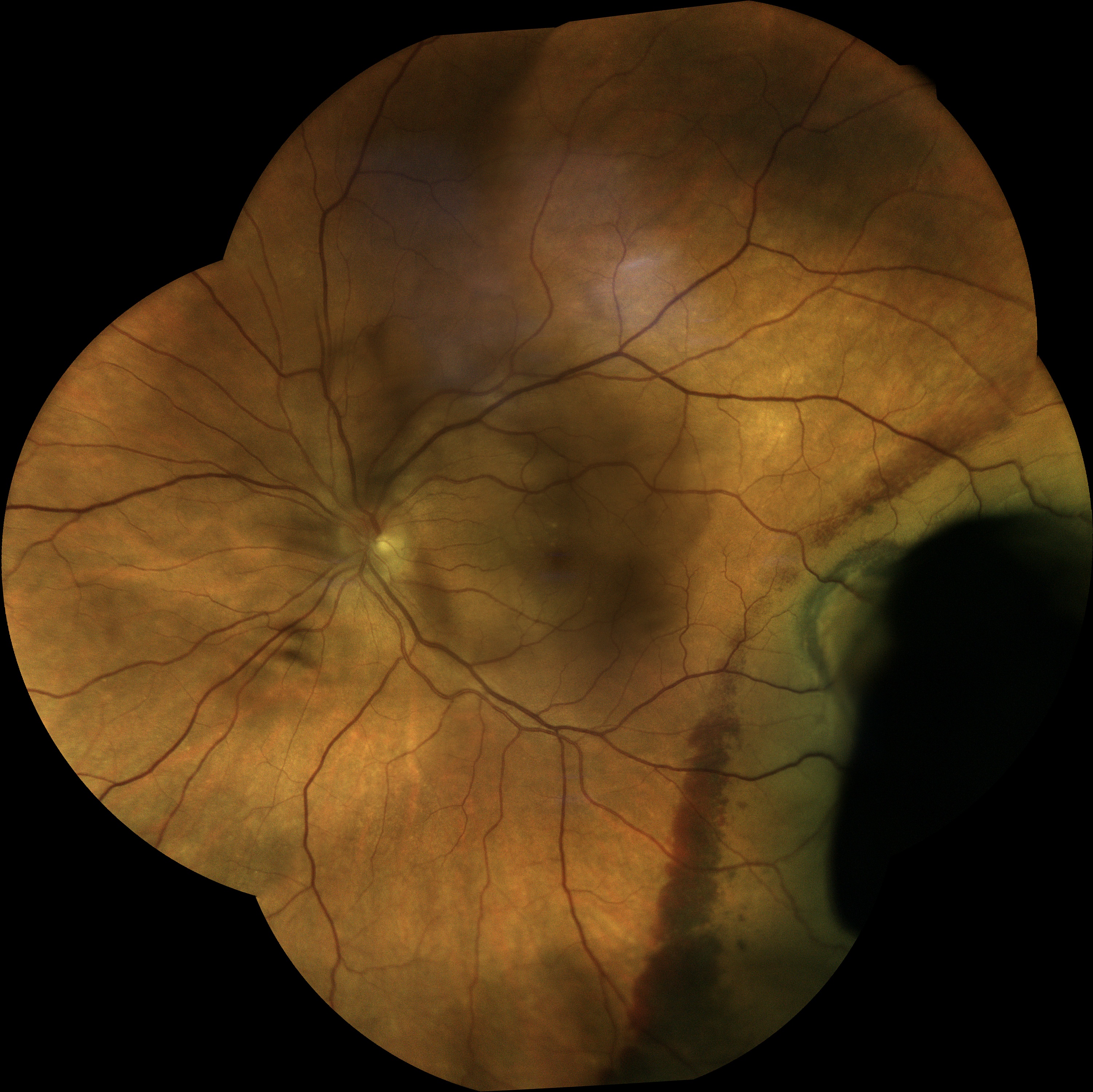  Melanoma / Courtesy of Dr Jean-Michel Muratet, Pamiers, France 