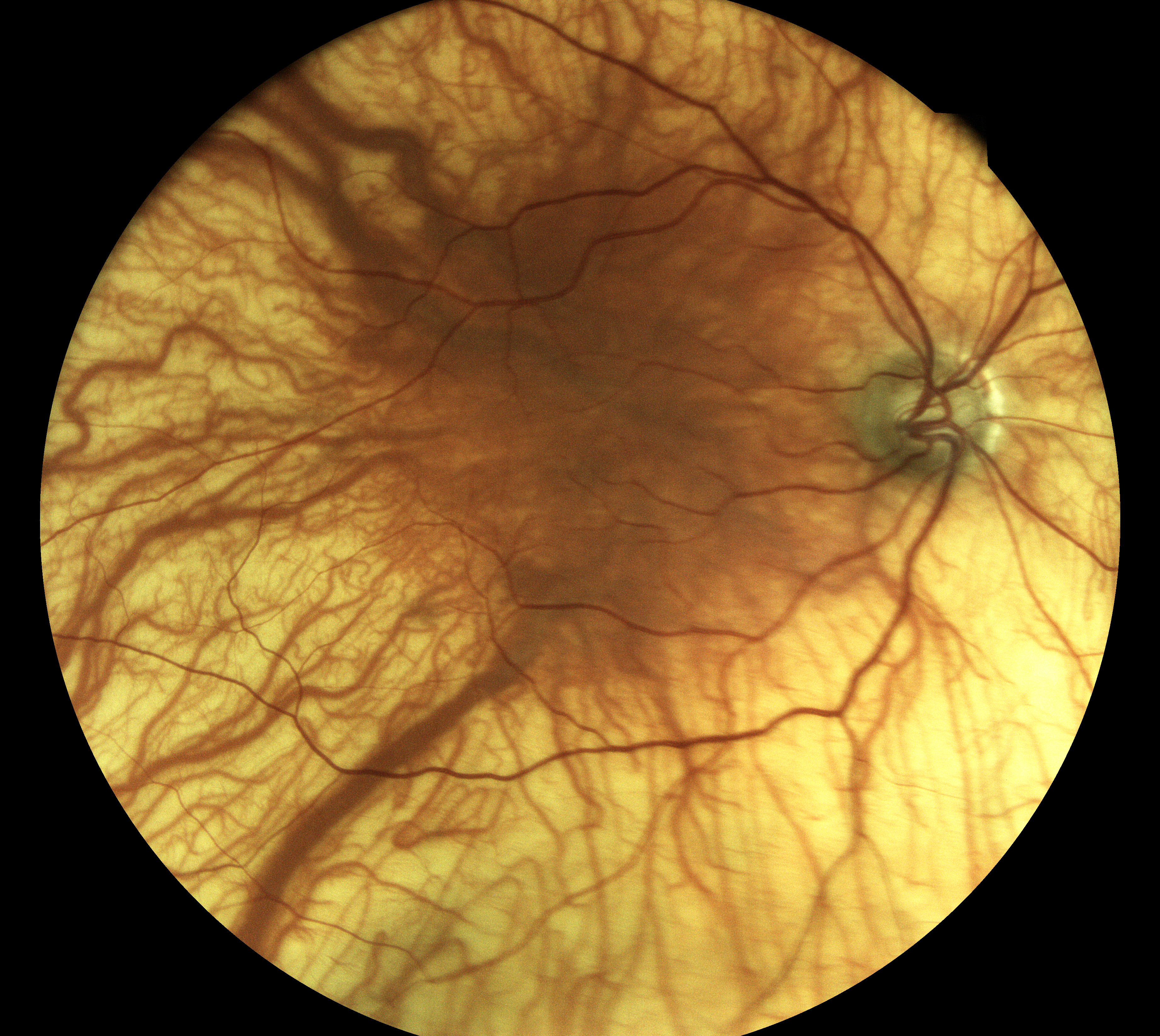  Albinism / Courtesy of Dr Pascal Liotta, Saint Dizier, France 