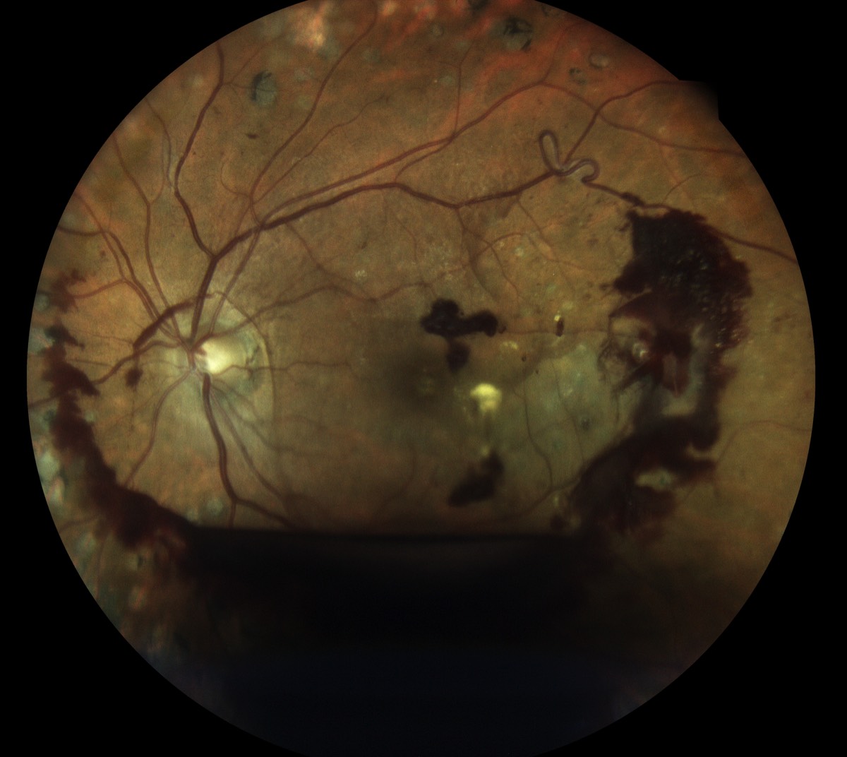 diabete retina retine retinal eidon
