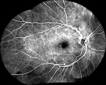 angiography fluoresceine eidon