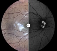 autofluo papillary drusen-gualino montauban