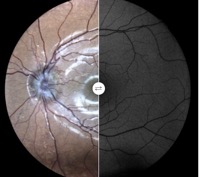 autofluorescence drusen gualino