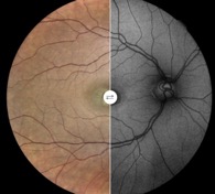 chloroquine autofluorescence maculopathy