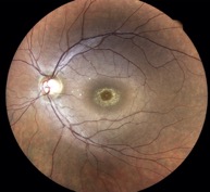 chloroquine autofluorescence maculopathy