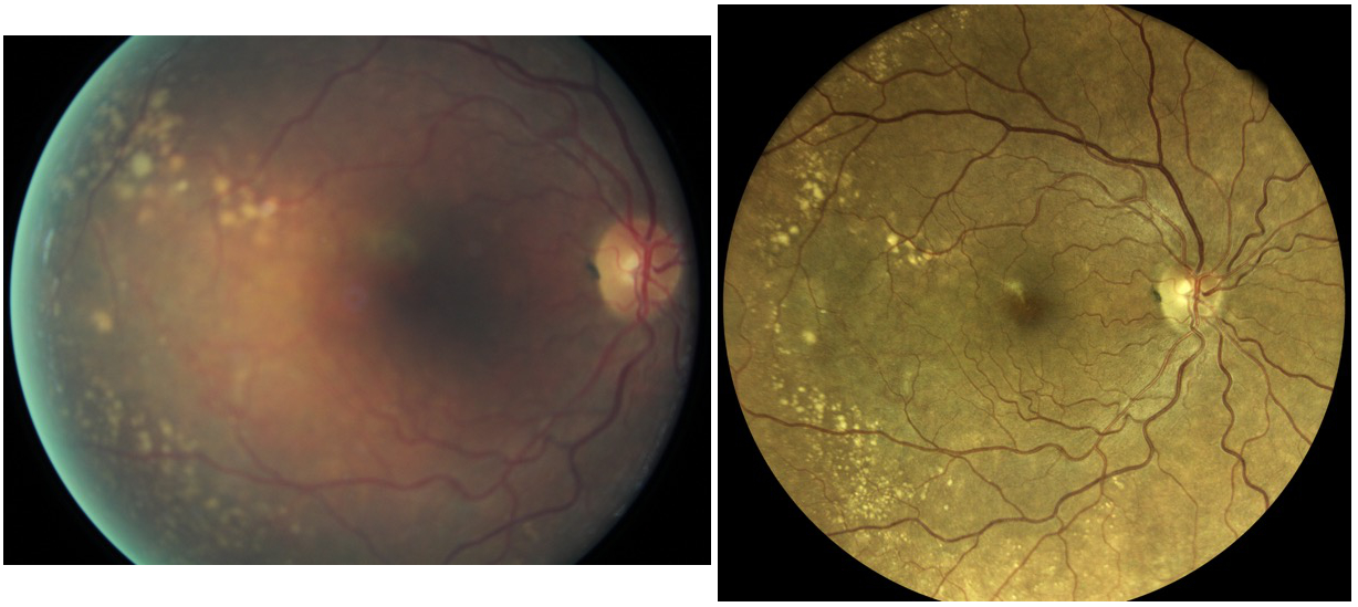 comparaison gualino retina eidon cataract