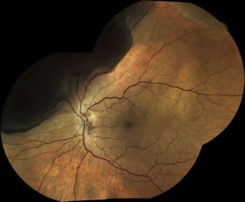 dr eidon retinal detachment