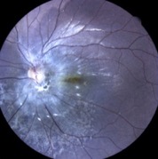 hartoma hamartome eidon retina child