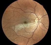 occlusion-artery eidon retina muratet