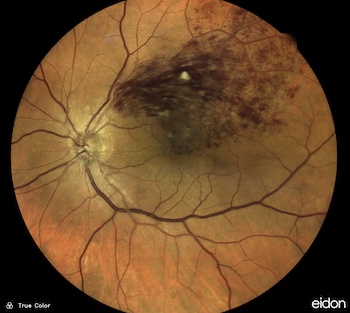 occlusion-branch-vein-retina-mini