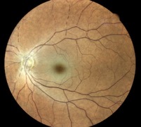 retinal-artery-occlusion EIDON muratet retina