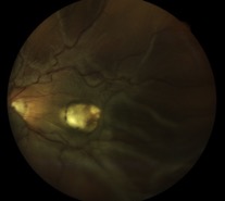 retinal-detachment cataract eidon
