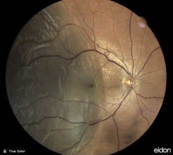 retinal-detachment muratet jean-michel