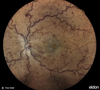 retinal-vein-occlusion-muratet-mini