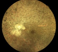 retinitis pigmentosa muratet pamiers