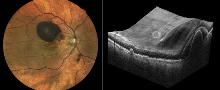 RPE-tears-fundus-optovue