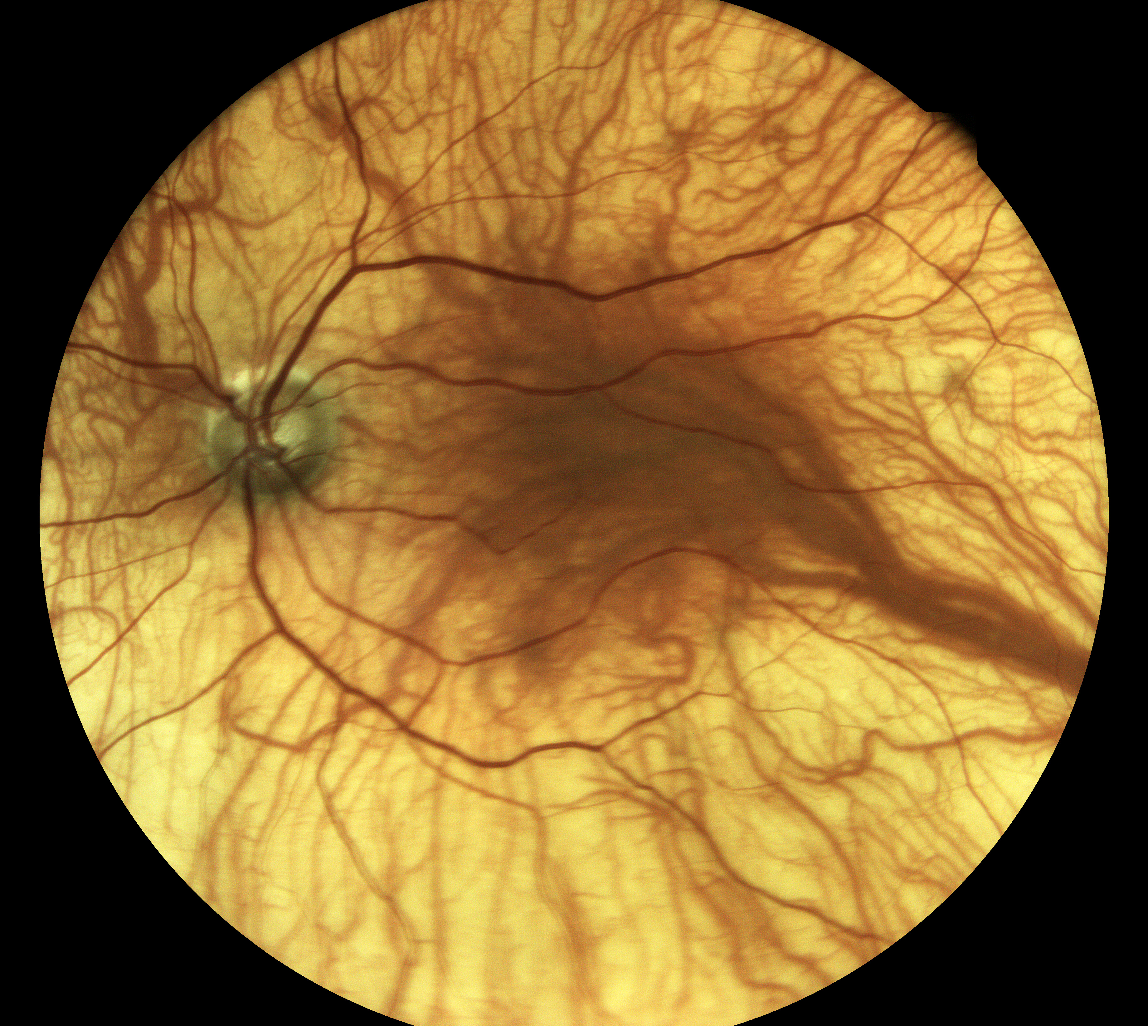 ocular albinism pascal liotta