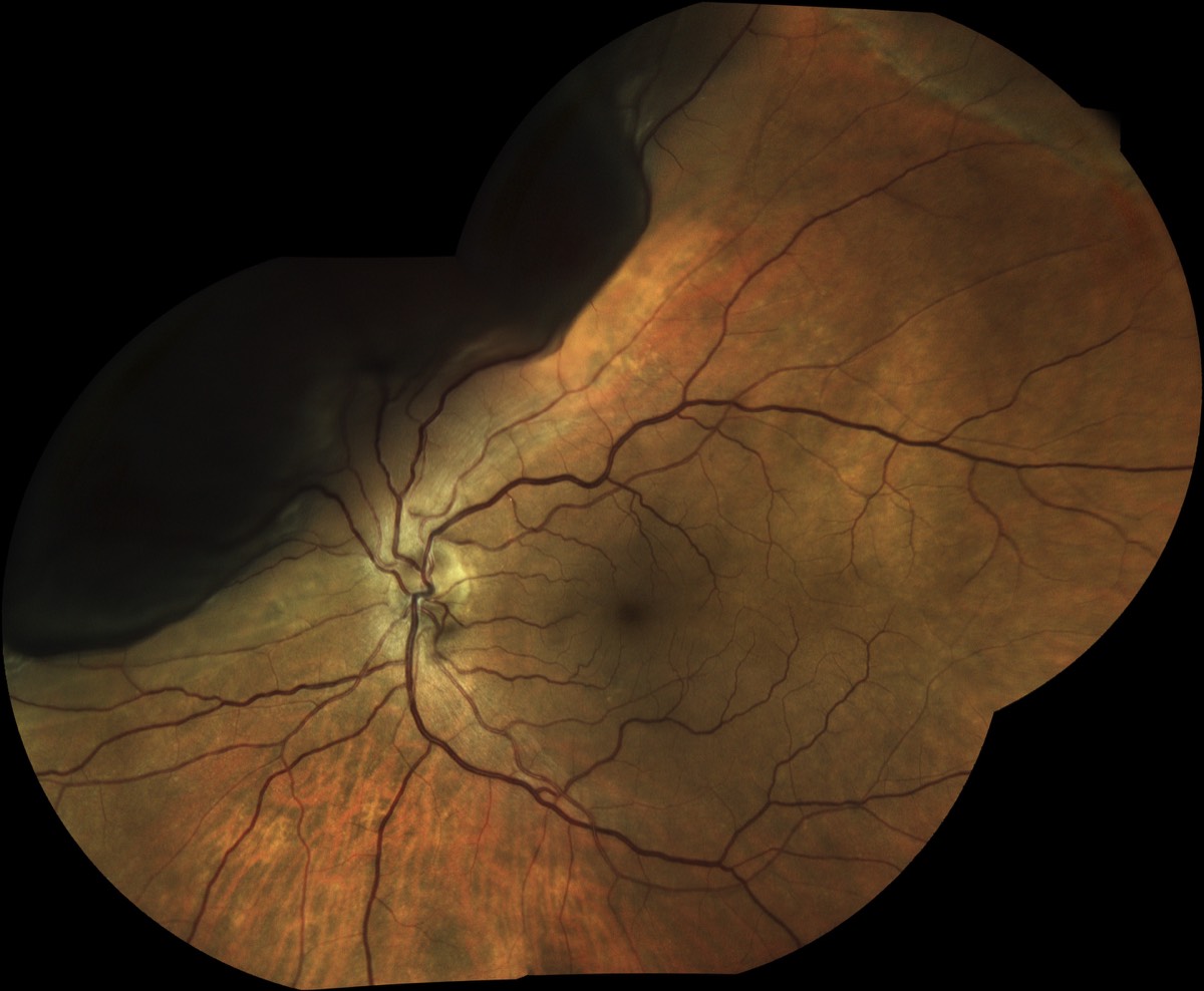 retinal detachment décollement rétine