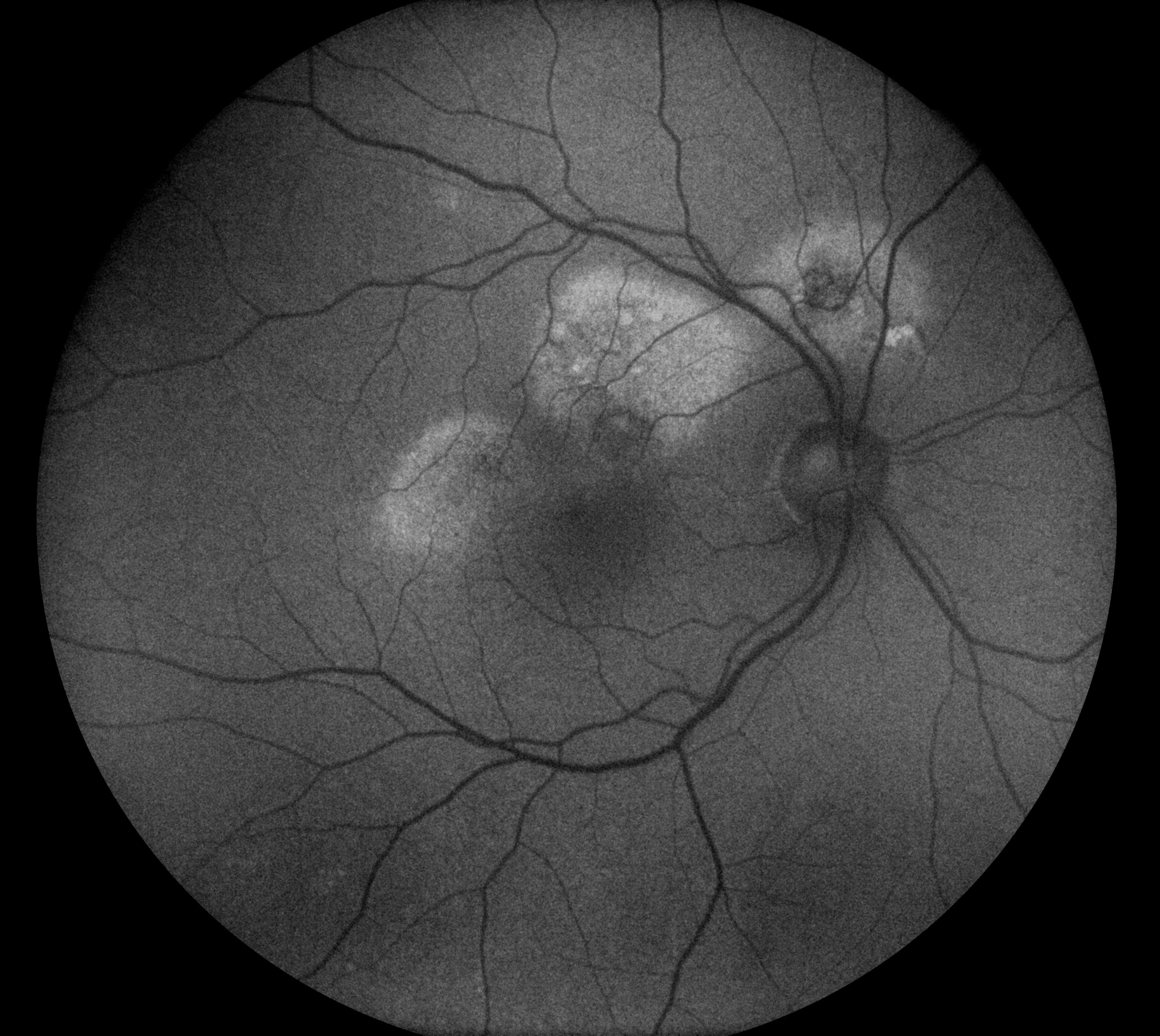 Serous chorioretinopathy (Eidon)